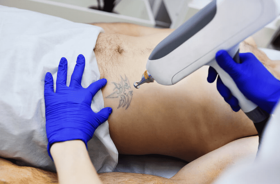 How to become a tattoo removal technician